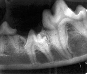 Impacted Premolar Tooth